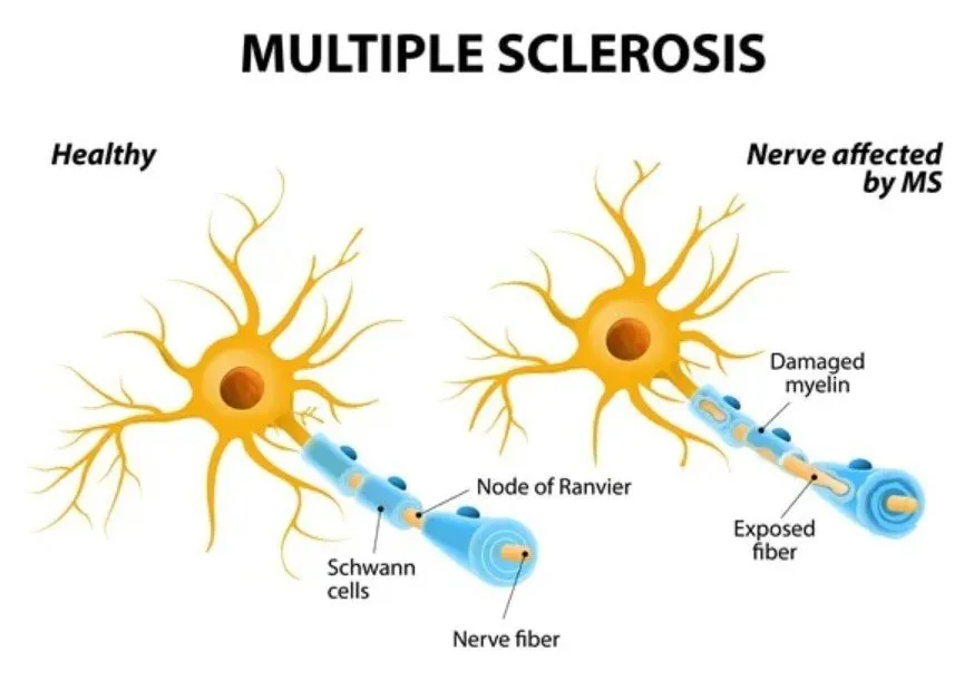 Everything You Should Know About Multiple Sclerosis