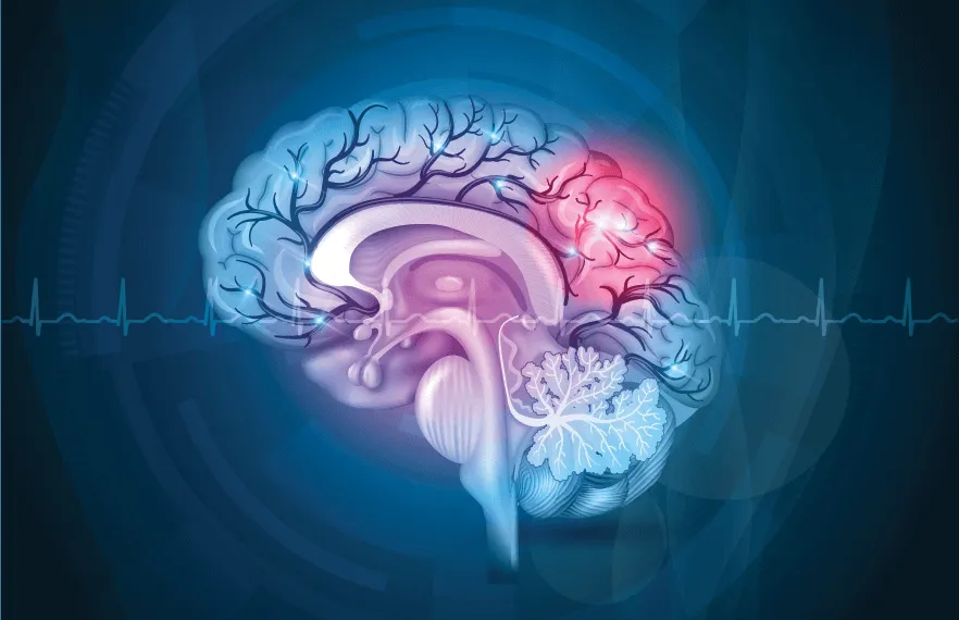 Understanding Stroke: An Urgent Call for Awareness