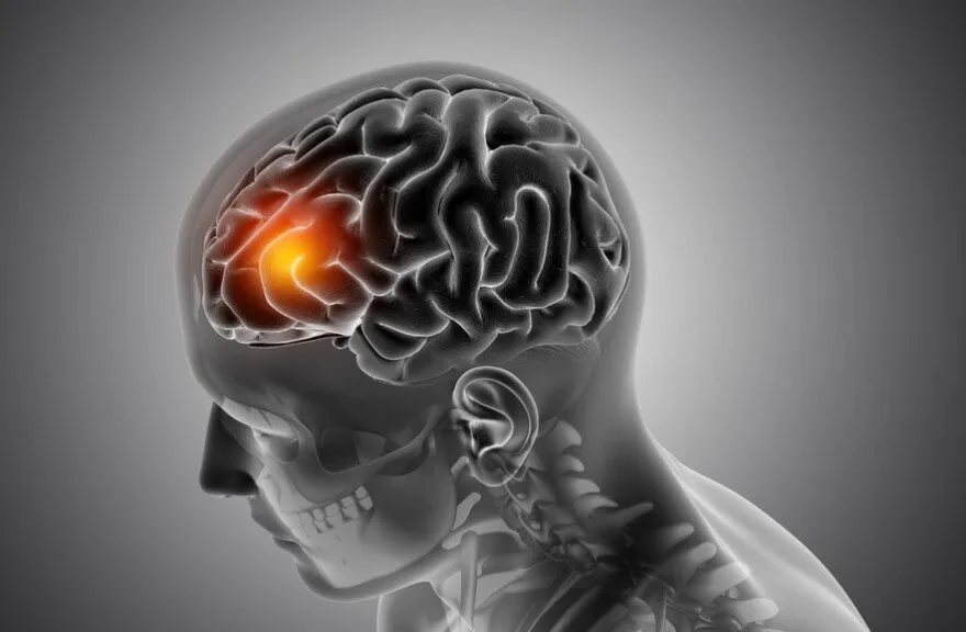 Acute Stroke: A Race Against Time