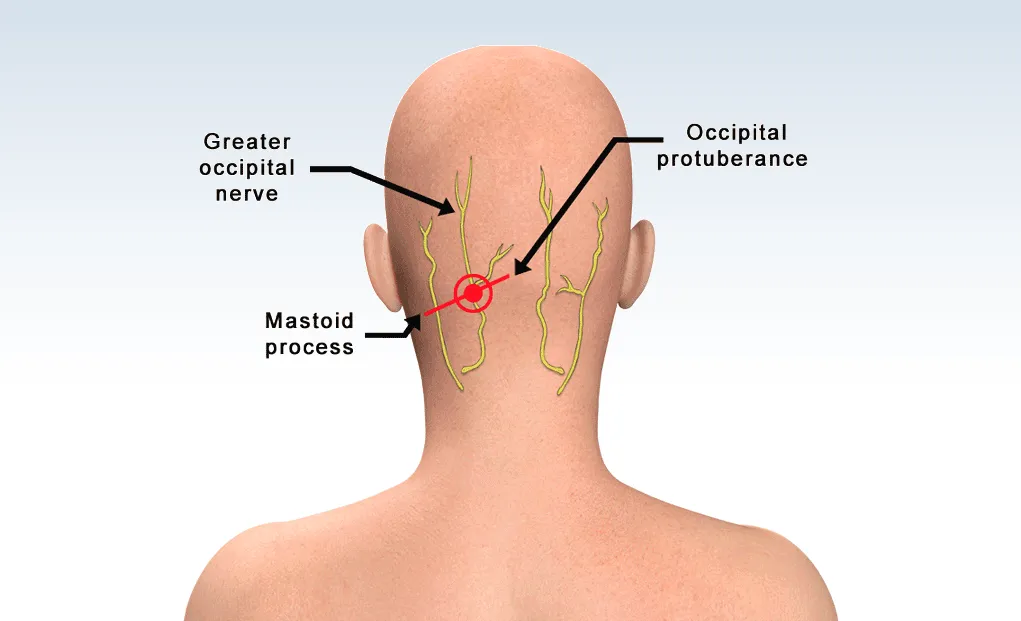 Targeted Pain Management: How GON Blocks (Greater Occipital Nerve Blocks) Alleviate Migraine Symptoms