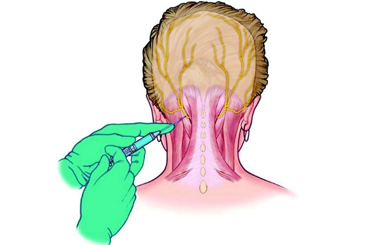 Minimally Invasive Migraine Solutions: Are Nerve Blocks the Future of Headache Treatment?