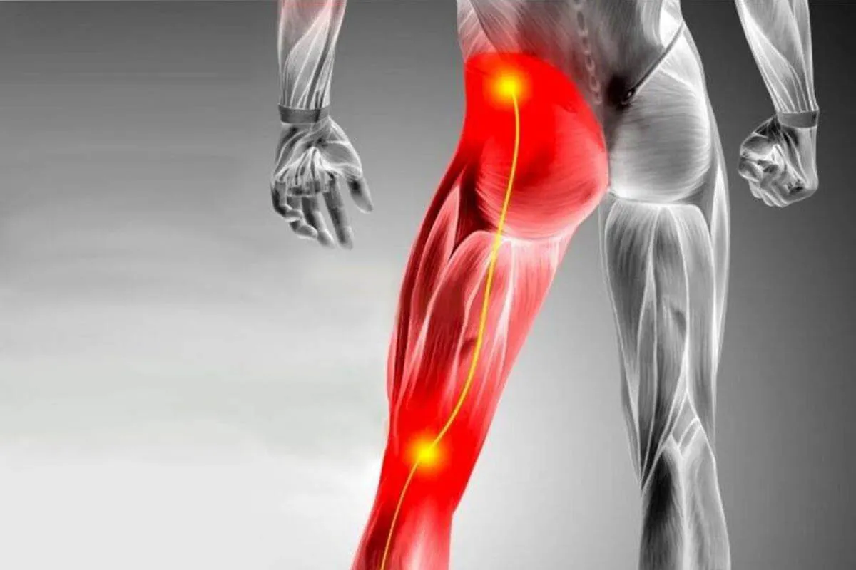 Sciatica Pain – Symptoms, Triggers & Neurological Treatments That Work