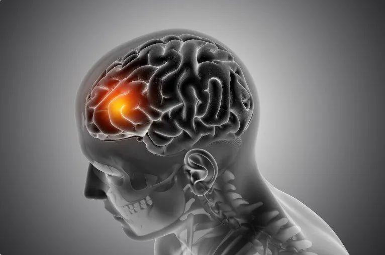 Stroke: Why Every Minute Really Does Count