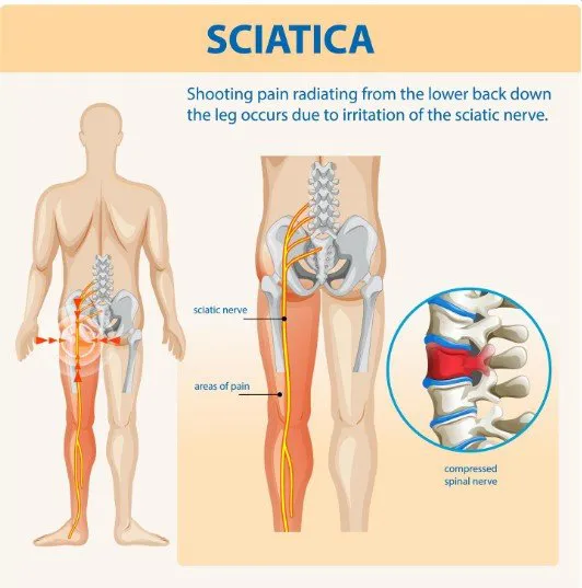 Sciatica Pain: Causes, Symptoms & Treatment by a Sciatica Doctor in Faridabad